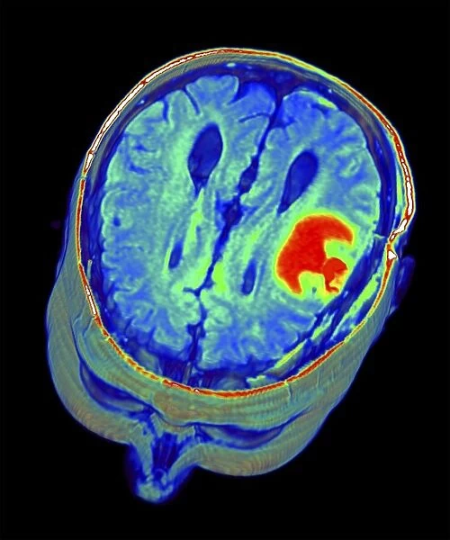 Brain tumour, 3D-MRI scan