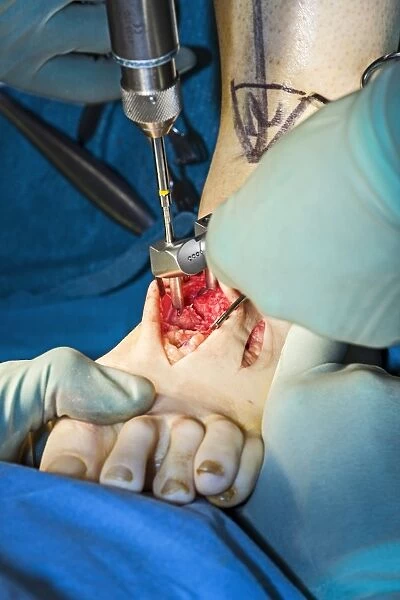 Cavus foot surgery, metatarsal pinning