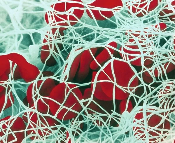 Coloured SEM of red blood cells forming a clot