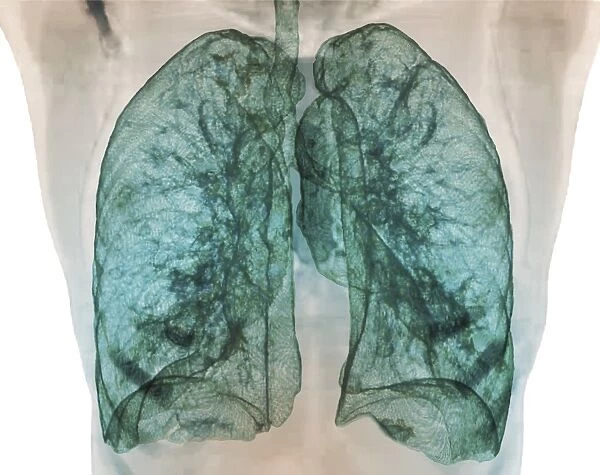 Healthy lungs, 3D CT scan F006  /  9100
