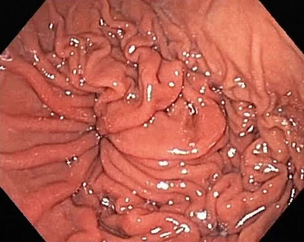 Hiatal hernia, endoscopic view C016  /  8329