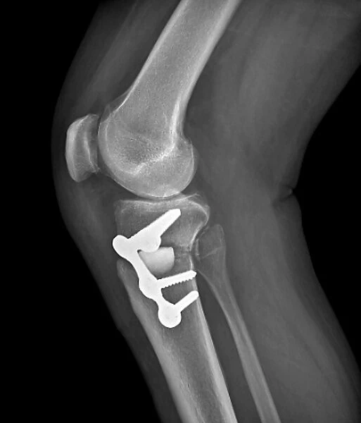 Knee realignment surgery, X-ray C016  /  6602