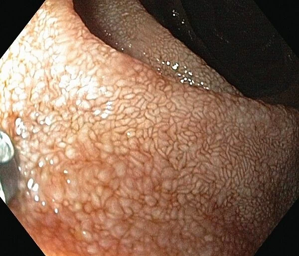 Lining of the duodenum, endoscopic view C016  /  8321
