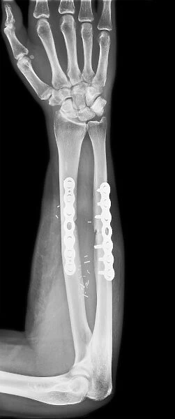 Pinned broken arm, X-ray C017  /  7869