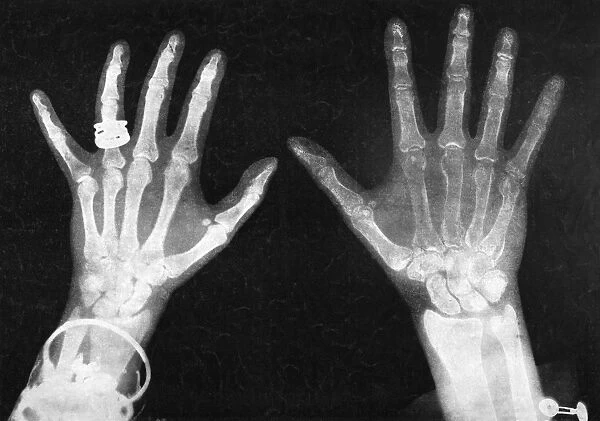 Hands of the Duchess of York, left, and the Duke of York in an X-ray, 1896
