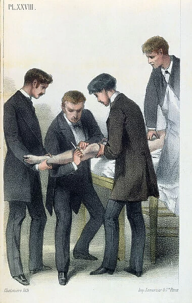 Amputating an arm, from a medical manual by Jean-Baptiste-Leon Dubreuil, c