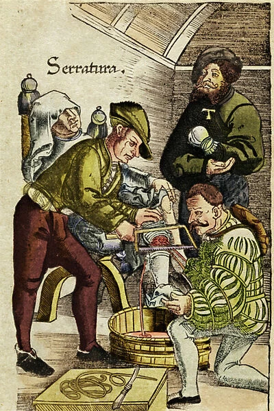 Amputation of a Limb, 1528 (woodcut)
