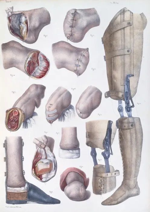 Framed Print : Amputations and Prosthetics, plate from Traite Complet de l Anatomie de l Homme by Jean-Baptiste Marc Bourgery (1797-1849) 1866-67 (coloured engraving)