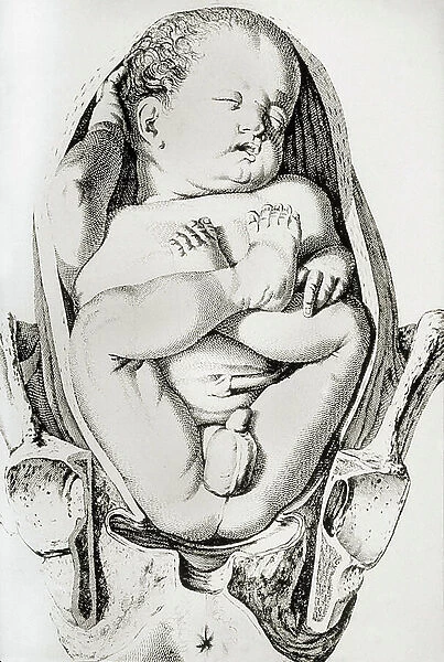 Anatomical board of a new born (fetus) poorly positioned at the time of birth. Engraving in 'Anatomiche Tafeln zur Hebammernkust' by W. Smellie, 19th century
