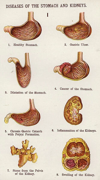 Diseases of the Stomach and Kidneys (colour litho)