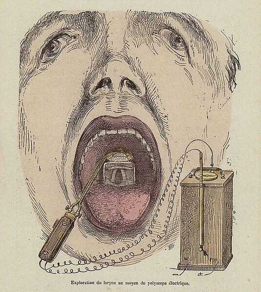 Examination of the larynx using an electric polyscope (coloured engraving)