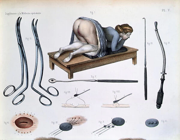 An operation on a vesicovaginal fistula, plate from Traite Complet de l Anatomie de l Homme by Jean-Baptiste Marc Bourgery (1797-1849) 1866-67 (coloured engraving)