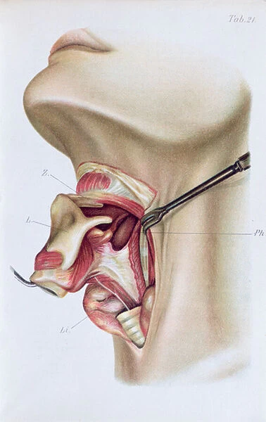 Plate from Atlas and Epitome of Operative Surgery by Dr