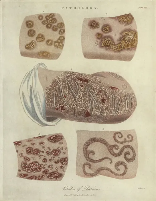 Framed Print : Psoriasis. 5855398 Psoriasis; (add.info.: Varieties of the autoimmune skin Framed Print : Psoriasis. 5855398 Psoriasis; (add.info.: Varieties of the autoimmune skin