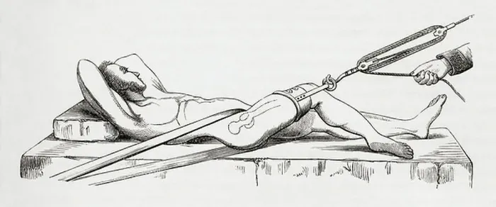 Framed Print : Reduction of dislocated thigh using pulleys. From The Household Physician, published c.1898 (engraving)