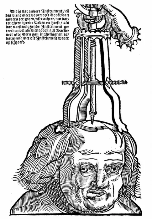 Framed Print : Trephination: Using an elevator to remove piece of bone from the skull. Woodcut from Hans von Gersdorf Veldt Boeck van den Chirugia Scheel-Hans, Amsterdam 1593