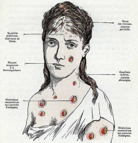 Young woman with syphilis presenting with plaques and pustules characteristic of the diseasee Engraving from ' La nature et l'homme' by Rengade 1881 Private collection