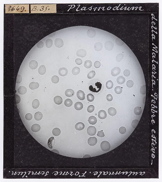 Malaria plasmodium enlarged under a microscope. Summer-Fall fever. Semi-lunar shapes