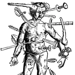 16th century woodcut of a woundman