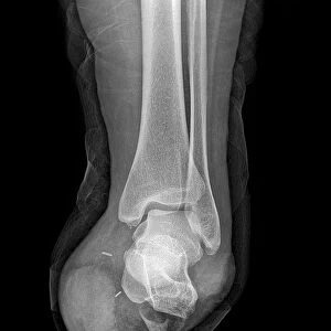 Amputated foot, X-ray C017 / 7386