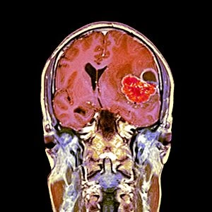 Brain cancer, MRI scan C016 / 4438