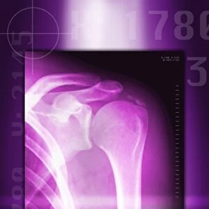Calcified shoulder joint, X-ray