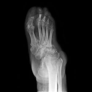 Charcot foot, X-ray C017 / 7581