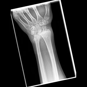 Dislocated wrist, X-ray C017 / 7565