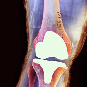 Knee joint prosthesis, X-ray
