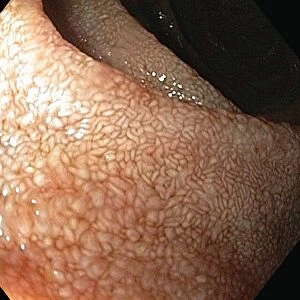 Lining of the duodenum, endoscopic view C016 / 8321