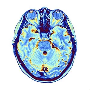 MRI brain scan F006 / 9208