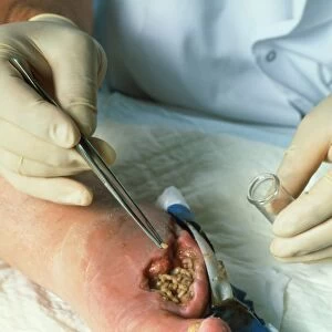 Surgeon placing maggots in a wound to clean it