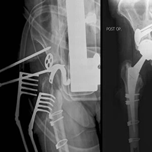 Total hip replacement, X-rays