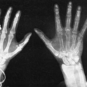 Hands of the Duchess of York, left, and the Duke of York in an X-ray, 1896