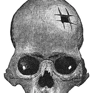 A trephined skull of ancient Peru. Wood engraving, late 19th century