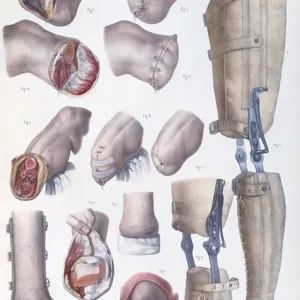 Amputations and Prosthetics, plate from Traite Complet de l Anatomie de l Homme by Jean-Baptiste Marc Bourgery (1797-1849) 1866-67 (coloured engraving)