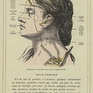 Electrisation du nerf facial, dans un cas de paralysie faciale (colour litho)