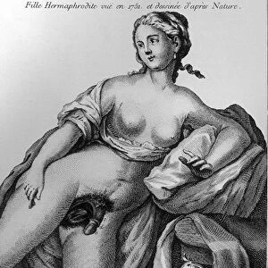 Hermaphrodite girl seen in 1751 and drawn from nature