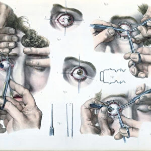 Operation on a strabismus, plate from Traite Complet de l Anatomie de l