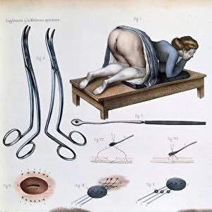 An operation on a vesicovaginal fistula, plate from Traite Complet de l Anatomie de l Homme by Jean-Baptiste Marc Bourgery (1797-1849) 1866-67 (coloured engraving)