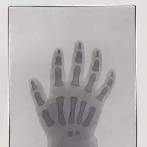 Skiagram of a Childs Hand (b / w photo)