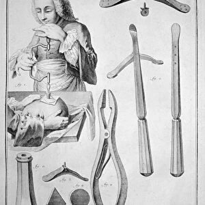 Trepanation of the skull, various instruments (engraving, 1772)