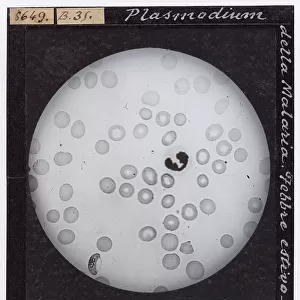 Malaria plasmodium enlarged under a microscope. Summer-Fall fever. Semi-lunar shapes
