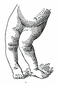 Skeletal Prints: The affects of Rickets