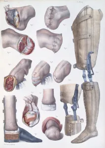Limbs Prints: Amputations and Prosthetics