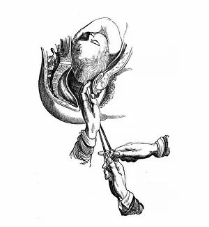 Anatomical Prints: Craniotomy