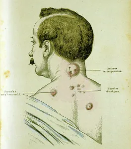 Vaccine Prints: Development of pustules in a man suffering from Anthrax, 19th century (engraving)