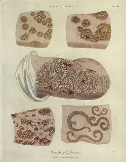 Stipple Prints: Psoriasis