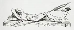 Joint Prints: Reduction of dislocated thigh using pulleys